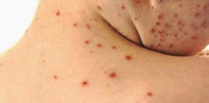 morbillo